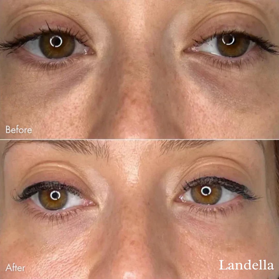 AlwaysdwellTM - 🔥Hot Sale 49% OFF💥Landella MicroGlow Patches